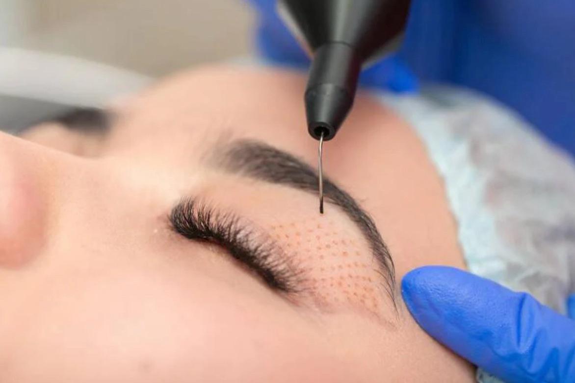 tratamento de Blefaroplastia sem Corte