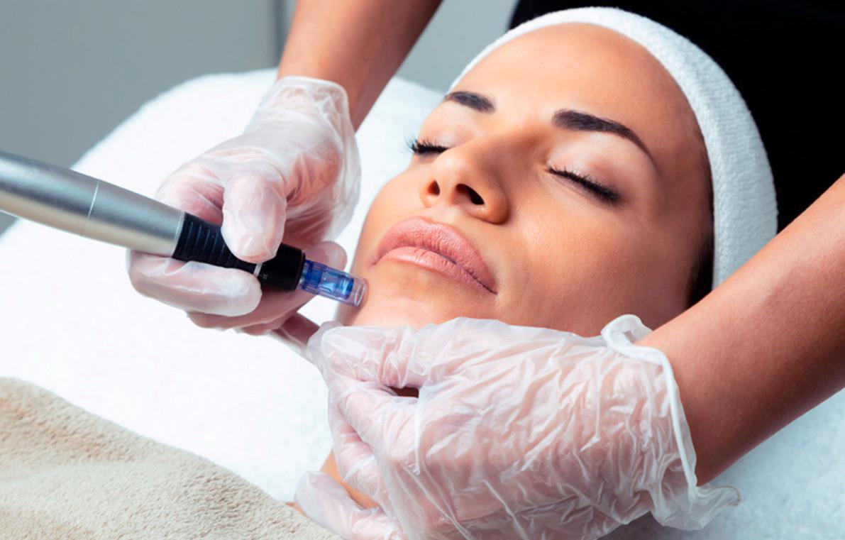 tratamento de Microagulhamento