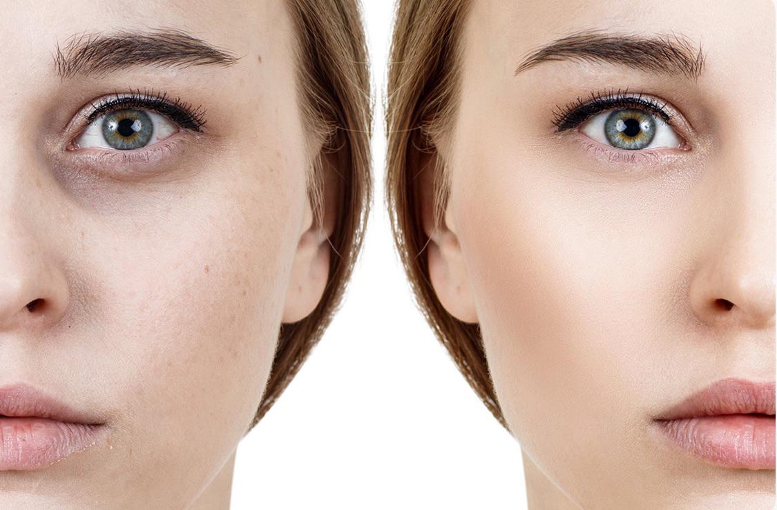 tratamento de Preenchimento de Olheiras